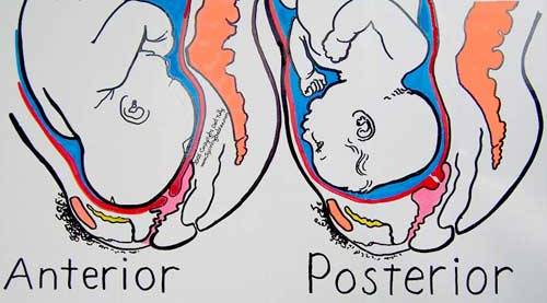 Posterior Baby Birth